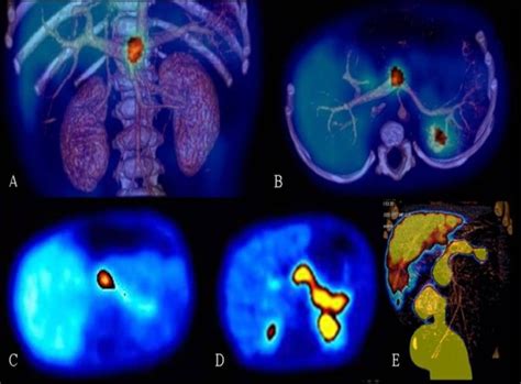 Cancer Biology Diagnosing Pancreatic Cancer Using A Pet Scan