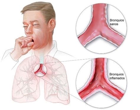 Información básica sobre el resfriado de pecho bronquitis aguda