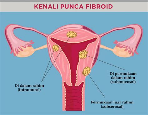 Adakah Fibroid Sejenis Kanser Cara Untuk Kenal Pasti Dan Rawat Fibroid