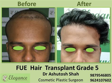 Hair Transplant Fue Method Grade 5 In Vesu Surat