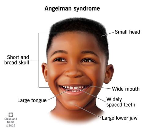 Sindrome De Algeman - Cuadro Del Síndrome De Angelman