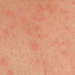 Hiv Aids Rash Current Health Advice Health Blog Articles And Tips