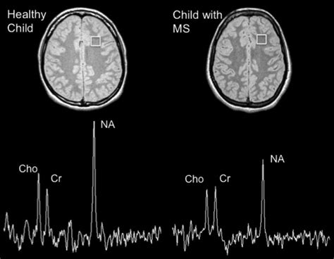 Advanced Magnetic Resonance Imaging In Pediatric Multiple Sclerosis