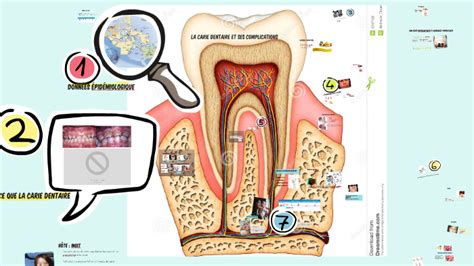 La carie dentaire et ses complications by aurelie paul on Prezi