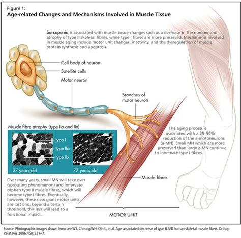 Sarcopenia And Muscle Aging