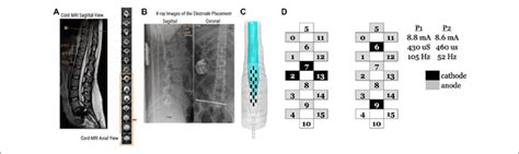 Site Of Implantation Of The Electrode Array And Stimulating Download Scientific Diagram