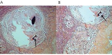 SciELO Brasil Genital Schistosomiasis Mansoni Concomitant To