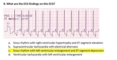 Ekg Interpretation With Answers Ecg Quiz And Review 55 Off