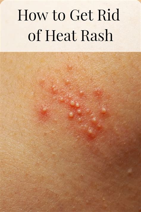 Heat Rash Pictures Symptoms Causes Types And Treatment 41 Off