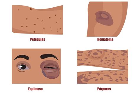 Por Que Ficamos Com Hematomas Lucoxcl