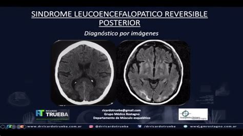 Sindrome Leucoencefalopatico Reversible Posterior Youtube