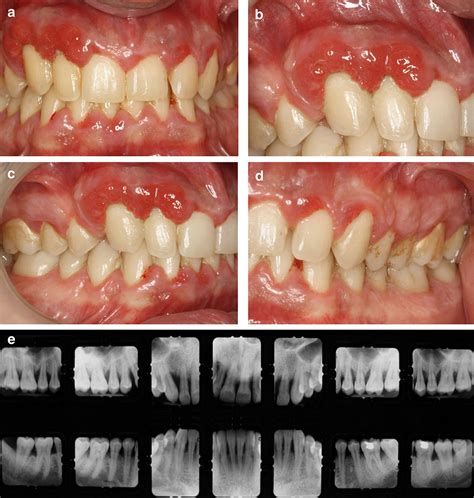 Plasma Cell Gingivitis