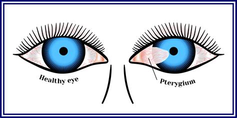 Pterygium | Skyline Vision | Surfer's Eye Colorado Springs, CO ...