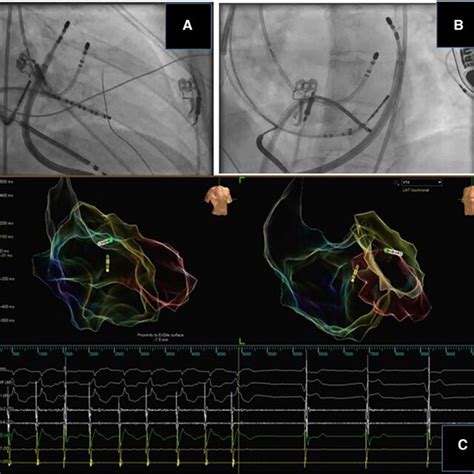 Bipolar Ablation For Intramural Substrate A Case Of Cardiac