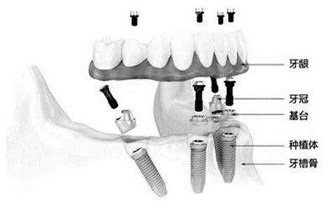 半口半固定种植牙怎样摘戴 看完种植流程你就知道了巨简单 种植牙 8682整形网