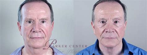 Facelift Before And After Photo Gallery Paramus New Jersey Parker Center For Plastic Surgery