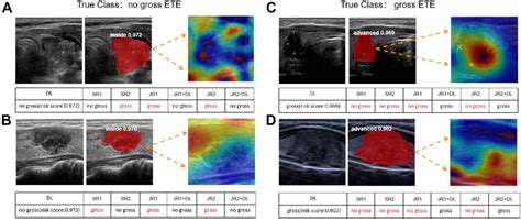 Ultrasound Image Based Deep Learning To Assist In Diagnosing Gross Extrathyroidal Extension