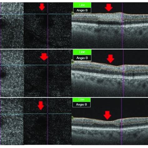 OCT angiography at different stages of RAO. (A) After two weeks, OCT ...