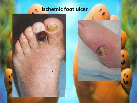 Diabetic Foot Gangrene