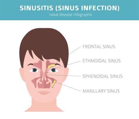 Sphenoid Sinus Disease Symptoms Captions Ideas