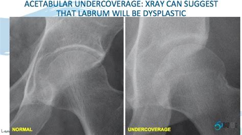 Dysplastic Labrum Acetabular Labrum More Than Just Tears Part