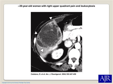 Absceso Hepatico Ppt