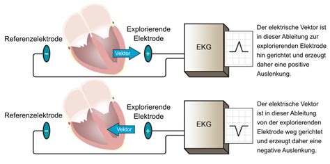 EKG Ableitungen Elektroden Extremitätenableitungen