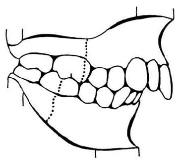 ABO Class II Molar RelationshipsABO American Board Of Orthodontics