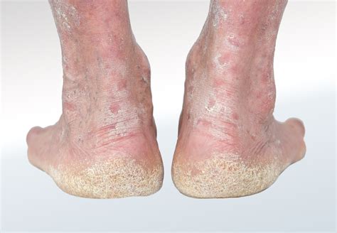 Psoriasis Relieve Foot Pain Leg Pain