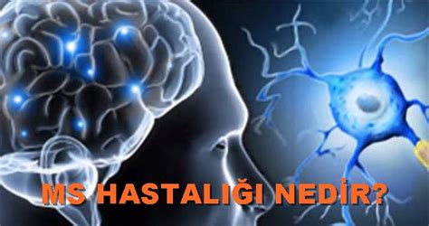 MS hastalığı nedir Belirtileri neler MS hastalığı tedavi