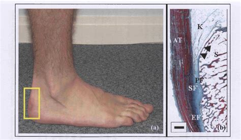 [PDF] Biomechanical analysis of the Achilles tendon enthesis organ | Semantic Scholar