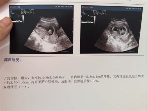 孕8周，好好的「胎芽」突然不見了？「胎停育」的這些信息要清楚 壹讀