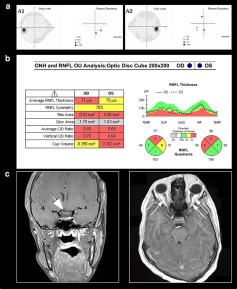 A 14 year-old child with right optic nerve glioma secondary to NF-1.... | Download Scientific ...