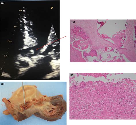 A Echocardiographic Evidence Of Aortic Valve Vegetation Fivechamber