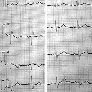 Electrocardiogram Ecg Obtained At Admission Shows Sinus Rhythm