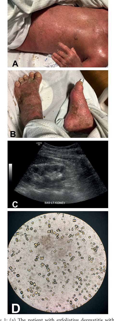 Figure From Erythrodermic Psoriasis Causing Uric Acid Crystal