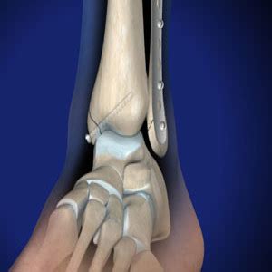 Ankle Fracture & Surgery in Plano, Frisco, McKinney and Allen