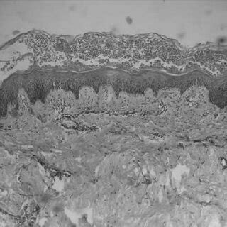 AGEP eruption in skin: Photomicrograph of skin showing sub-corneal ...