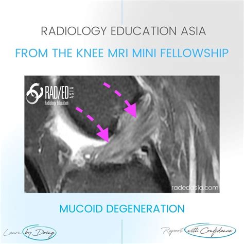 ACL MUCOID DEGENERATION RADIOLOGY MRI - Radedasia