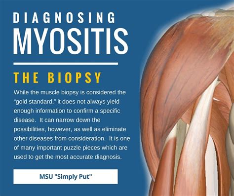 Diagnosing Myositis Updated Myositis Dermatomyositis Awareness