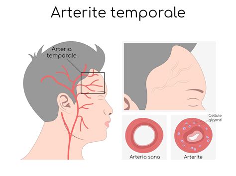 Sintomas De Arterite Temporal RETOEDU