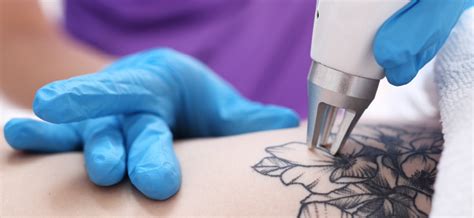 Como Remover Uma Tatuagem Tatto Clinic