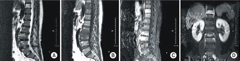 Figure 1 From Clinical Findings Of Brucellar Spondylitis A Case