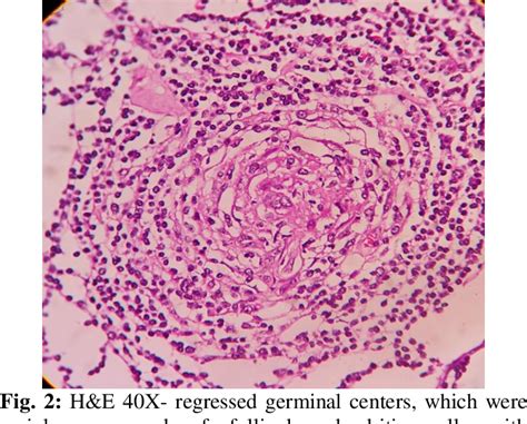 Figure 2 From A Rare Case Of Retroperitoneal Castleman Disease