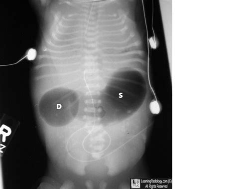 Duodenal Atresia