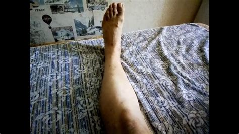 варикозное расширение вен, после операции - YouTube