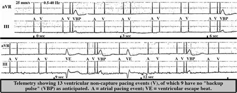 Po Ventricular Autocapturetm Failure In A Pacemaker Dependent