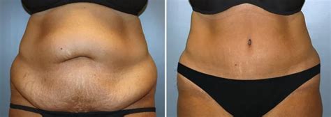 Achieving Abdominal Transformation Exploring Tummy Tuck Surgery