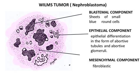 Wilms Tumor Nephroblastoma Pathology Made Simple