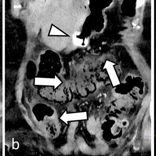 Abdominal Portal Venous Phase Dual Energy CT Dual Source 58 Year Old